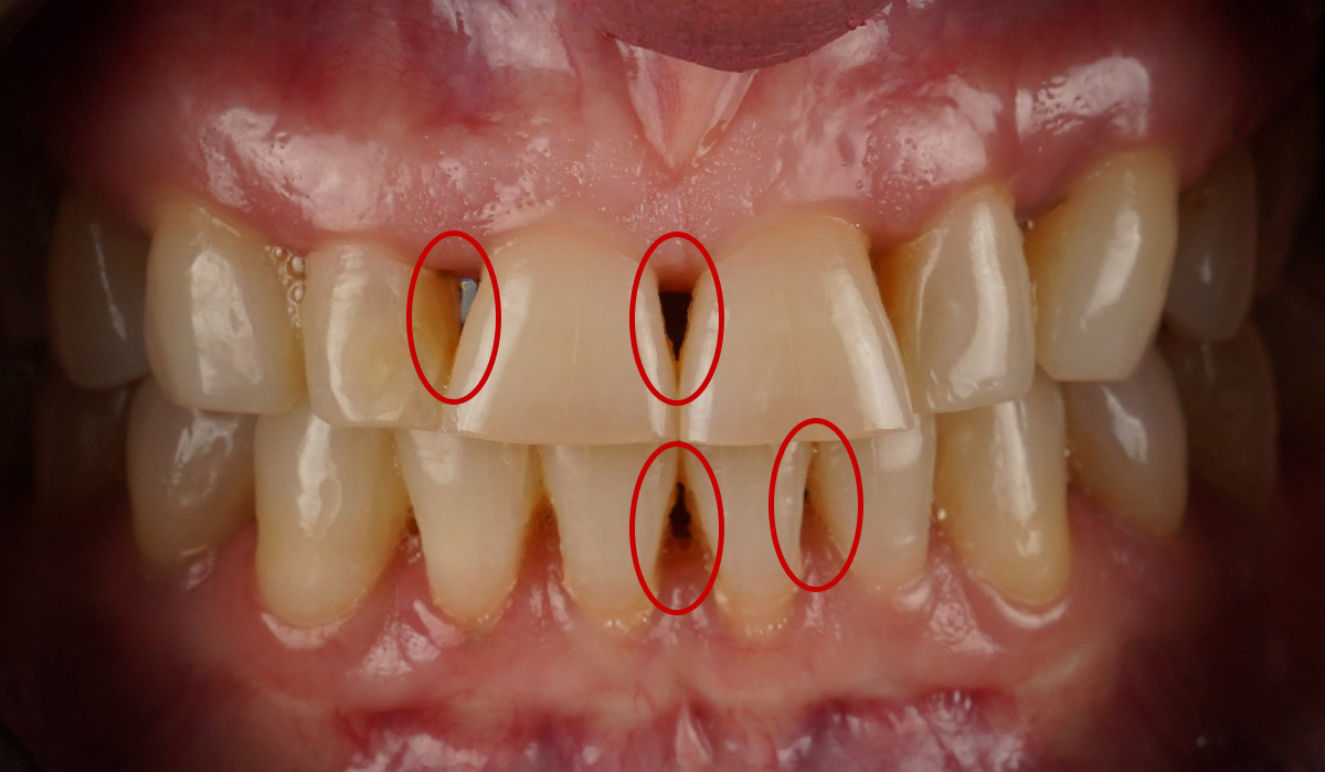 Lee más sobre el artículo Triángulos negros en los dientes: ¿Por qué aparecen?