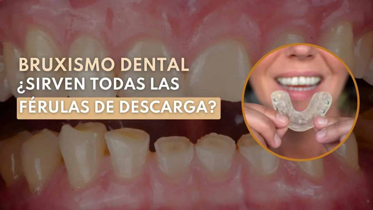 Férula Bruxismo Dental