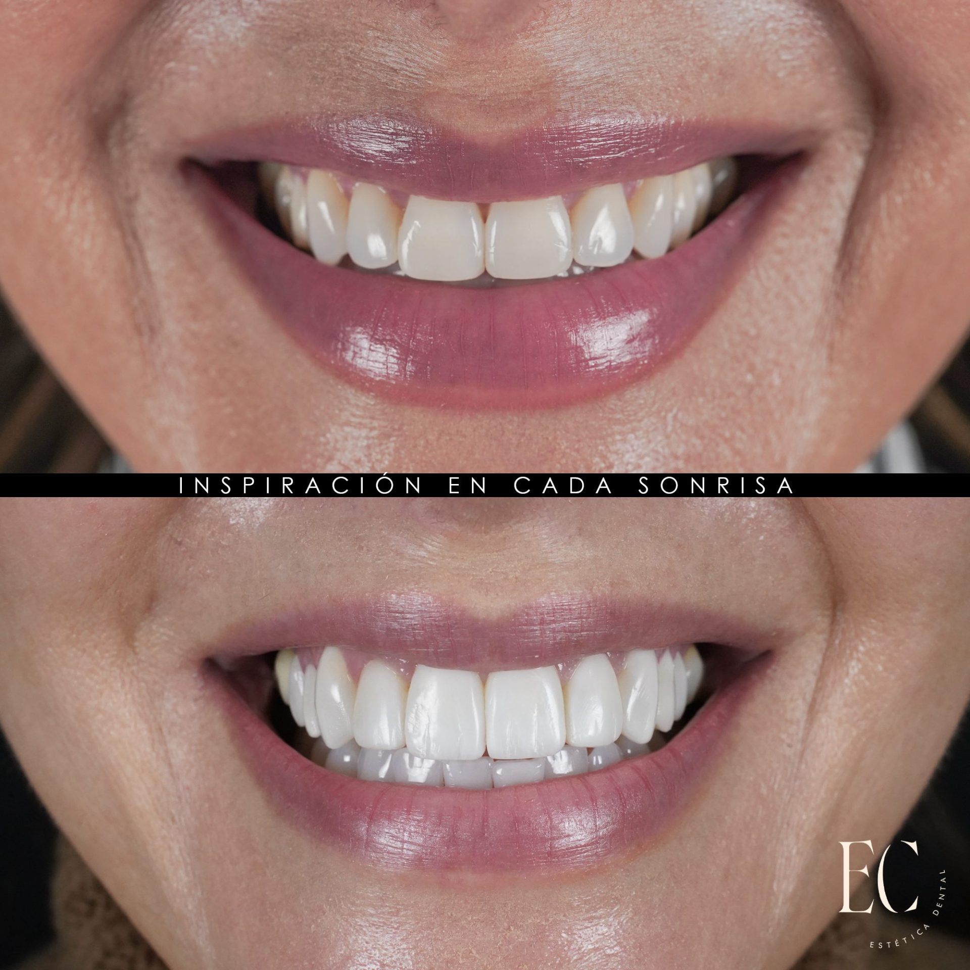 SONRISA ANTES Y DESPUES Eugenia Cervantes | Clínica Dental en Madrid