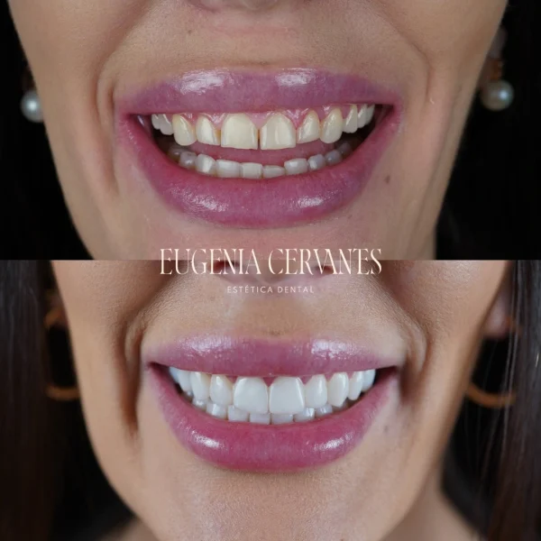 carillas en bruxistas mujer 600x600 1 Eugenia Cervantes | Clínica Dental en Madrid