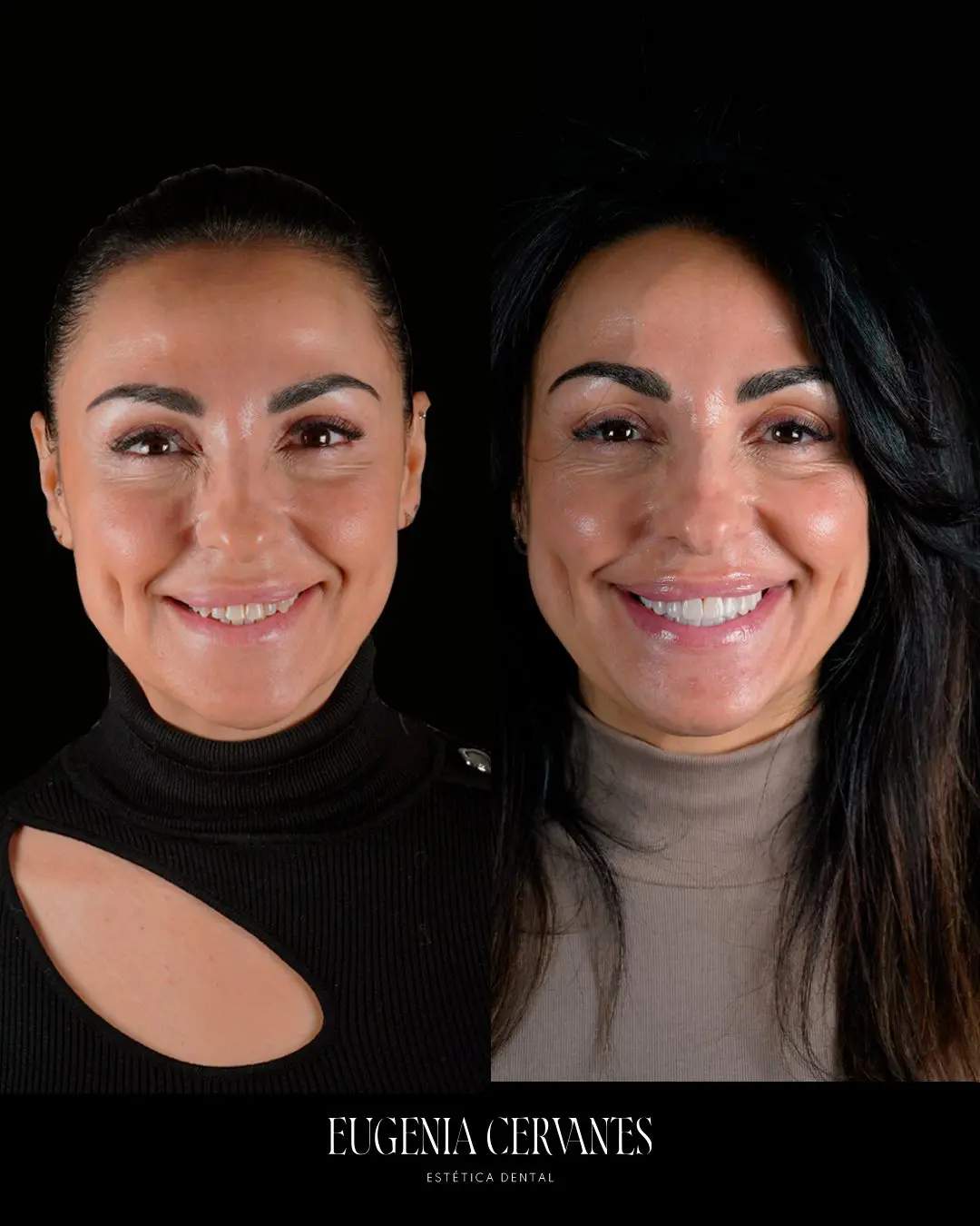 ANTES DESPS Eugenia Cervantes | Clínica Dental en Madrid
