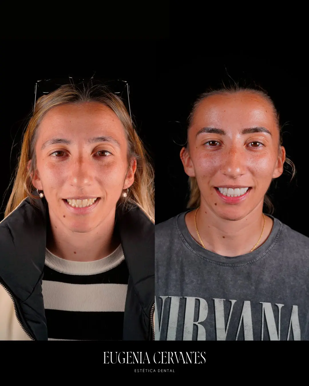 ANTES Eugenia Cervantes | Clínica Dental en Madrid