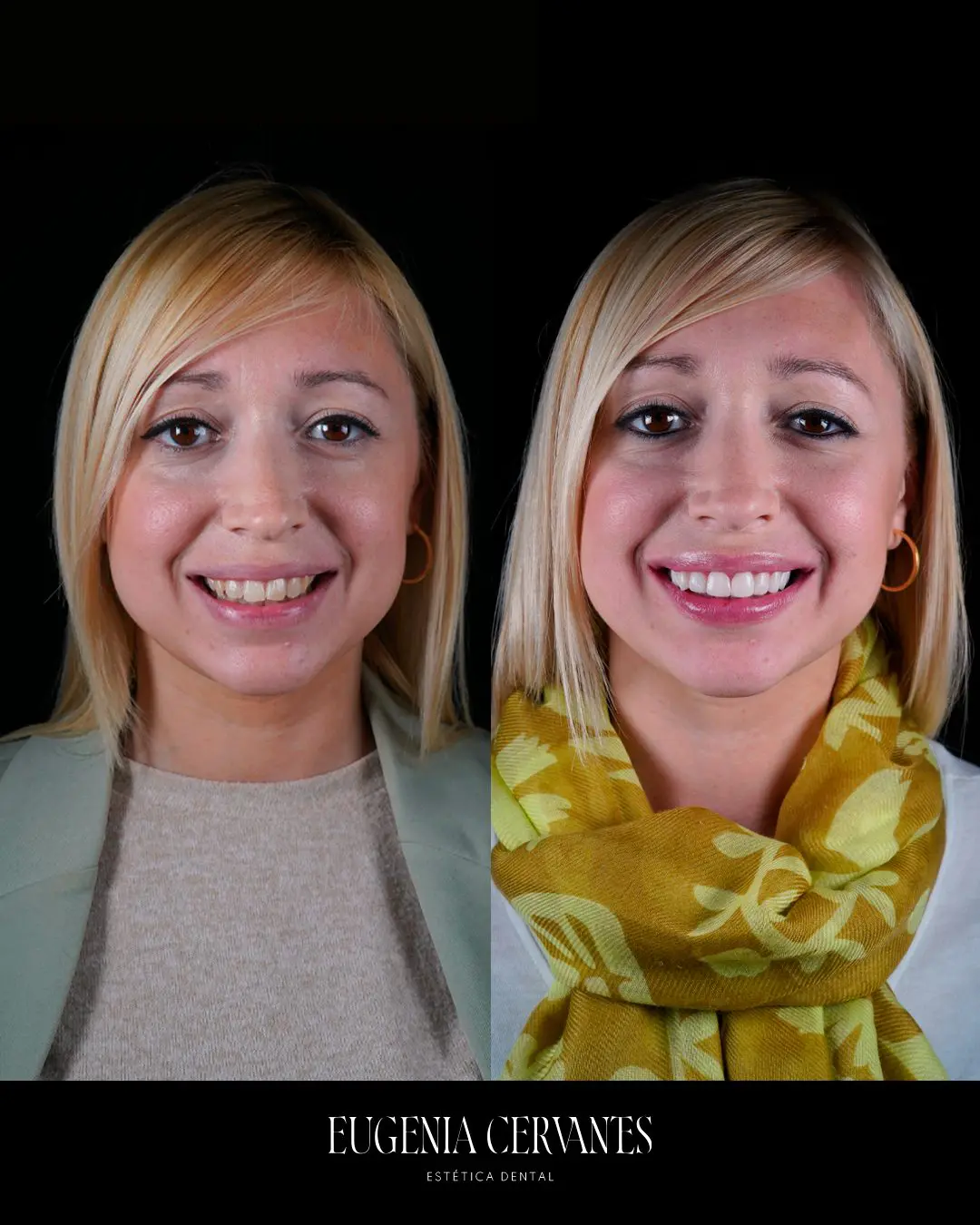 ANTES DESP sd Eugenia Cervantes | Clínica Dental en Madrid