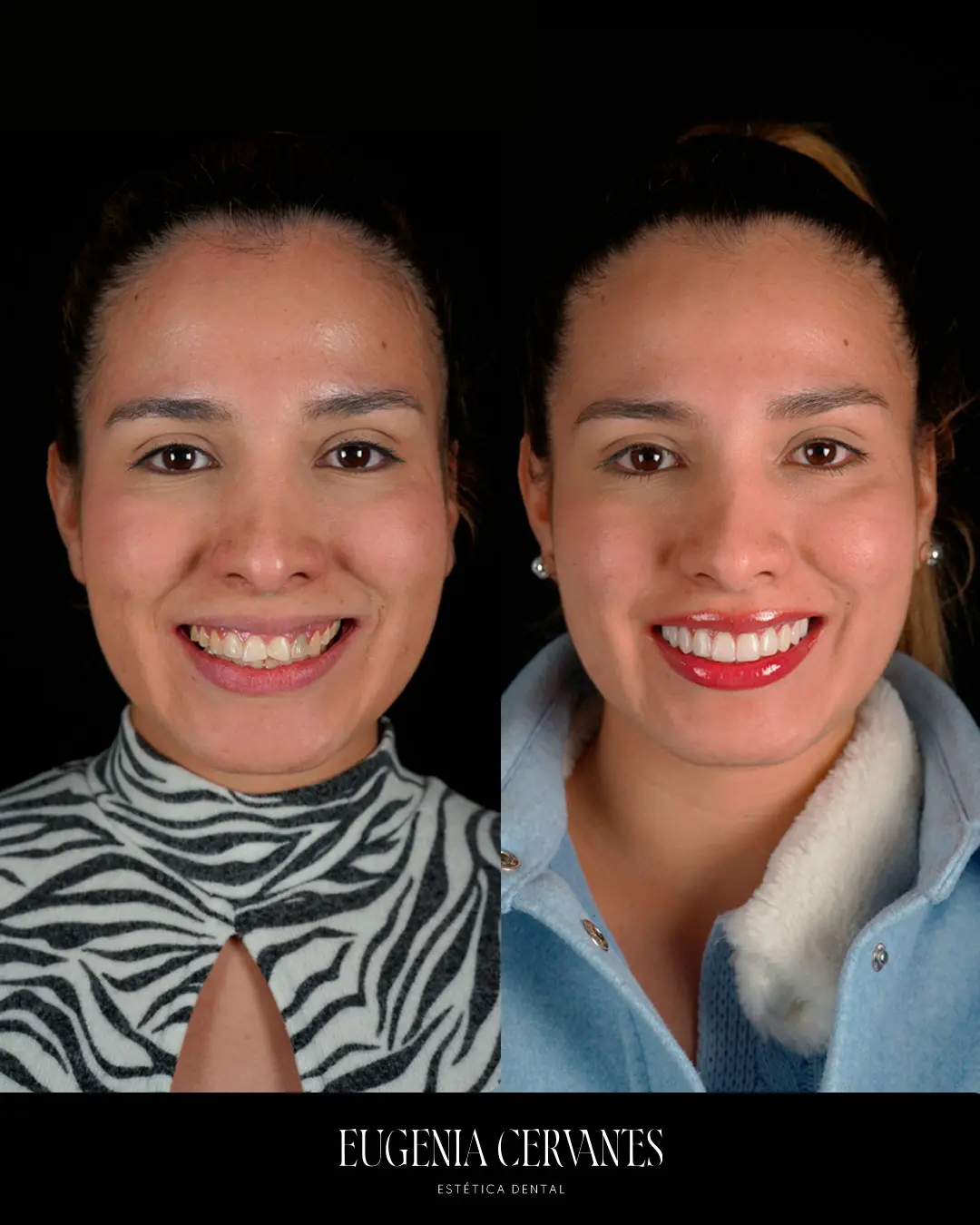 carillas de composite madrid sin tallado Eugenia Cervantes | Clínica Dental en Madrid