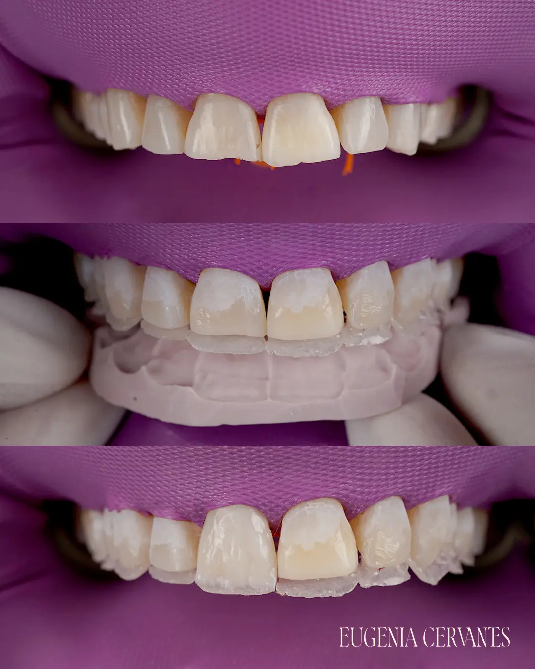 Antes, durante y después del tratamiento con carillas de composite, mostrando la mejora en la apariencia de la sonrisa.