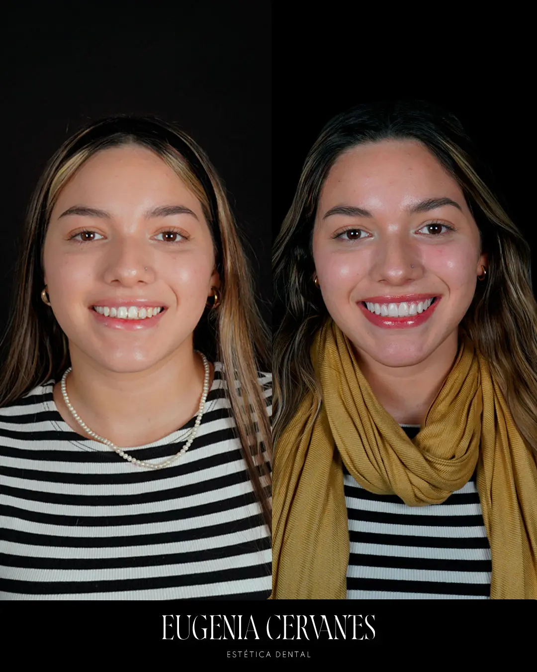 eugenia cervantes antes y despues Eugenia Cervantes | Clínica Dental en Madrid