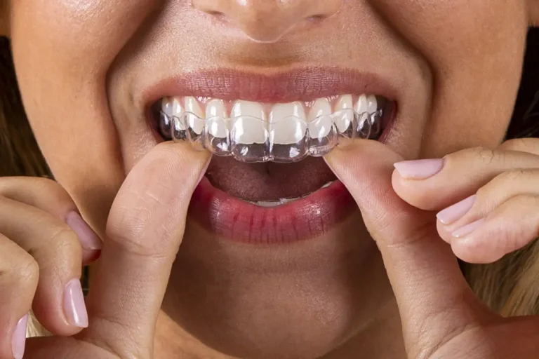 boca de una mujer mientras se pone su ortodoncia invisible