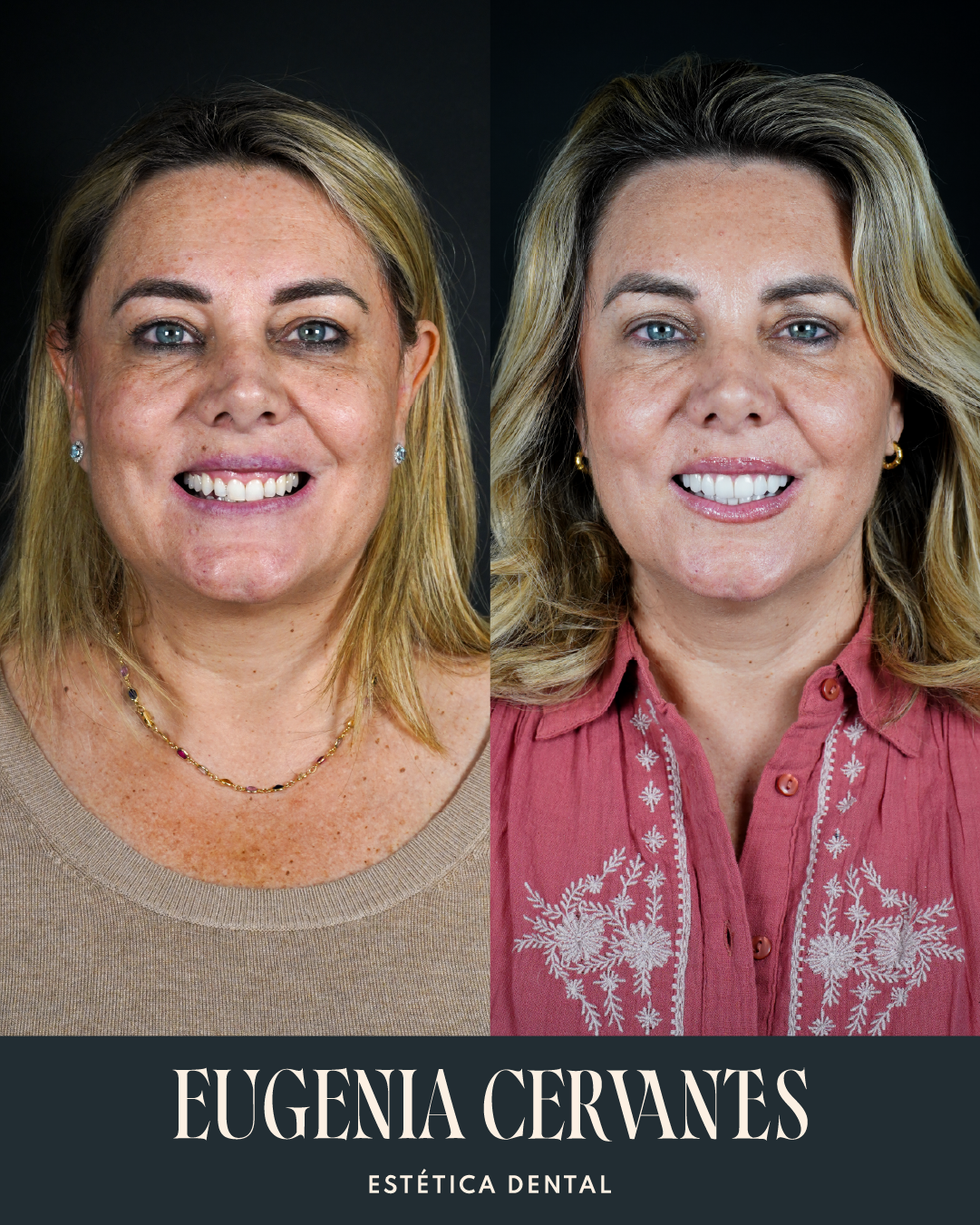 Antes y Despues Herminia Rodriguez CARA Eugenia Cervantes | Clínica Dental en Madrid