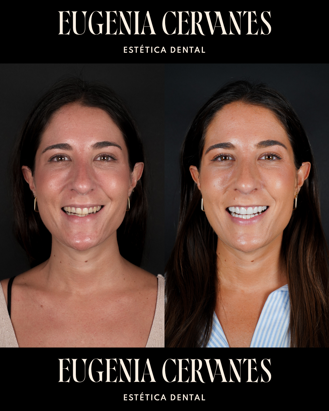 Antes y Despues Daniela Echave CARA Eugenia Cervantes | Clínica Dental en Madrid
