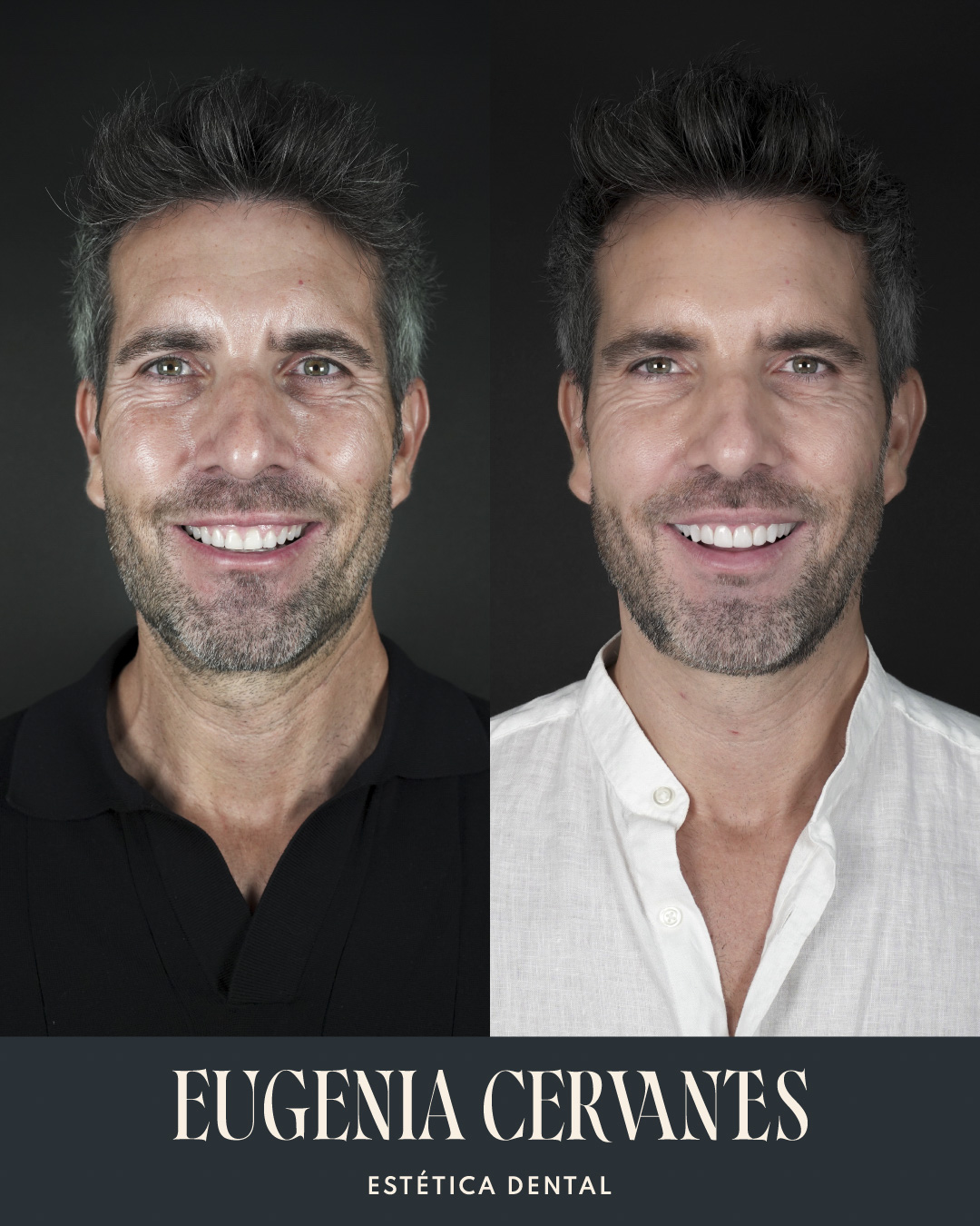 Antes y Despues Diego Rodriguez De Celis 2 Eugenia Cervantes | Clínica Dental en Madrid