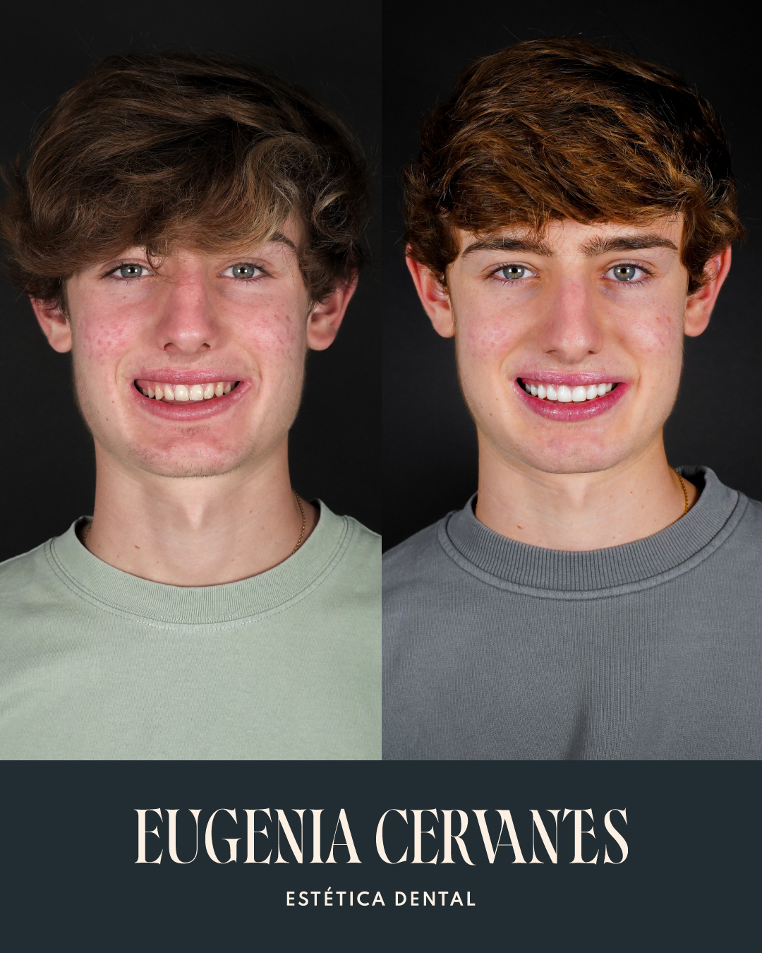 Antes y Despues Luis Gonzalez CARA Eugenia Cervantes | Clínica Dental en Madrid