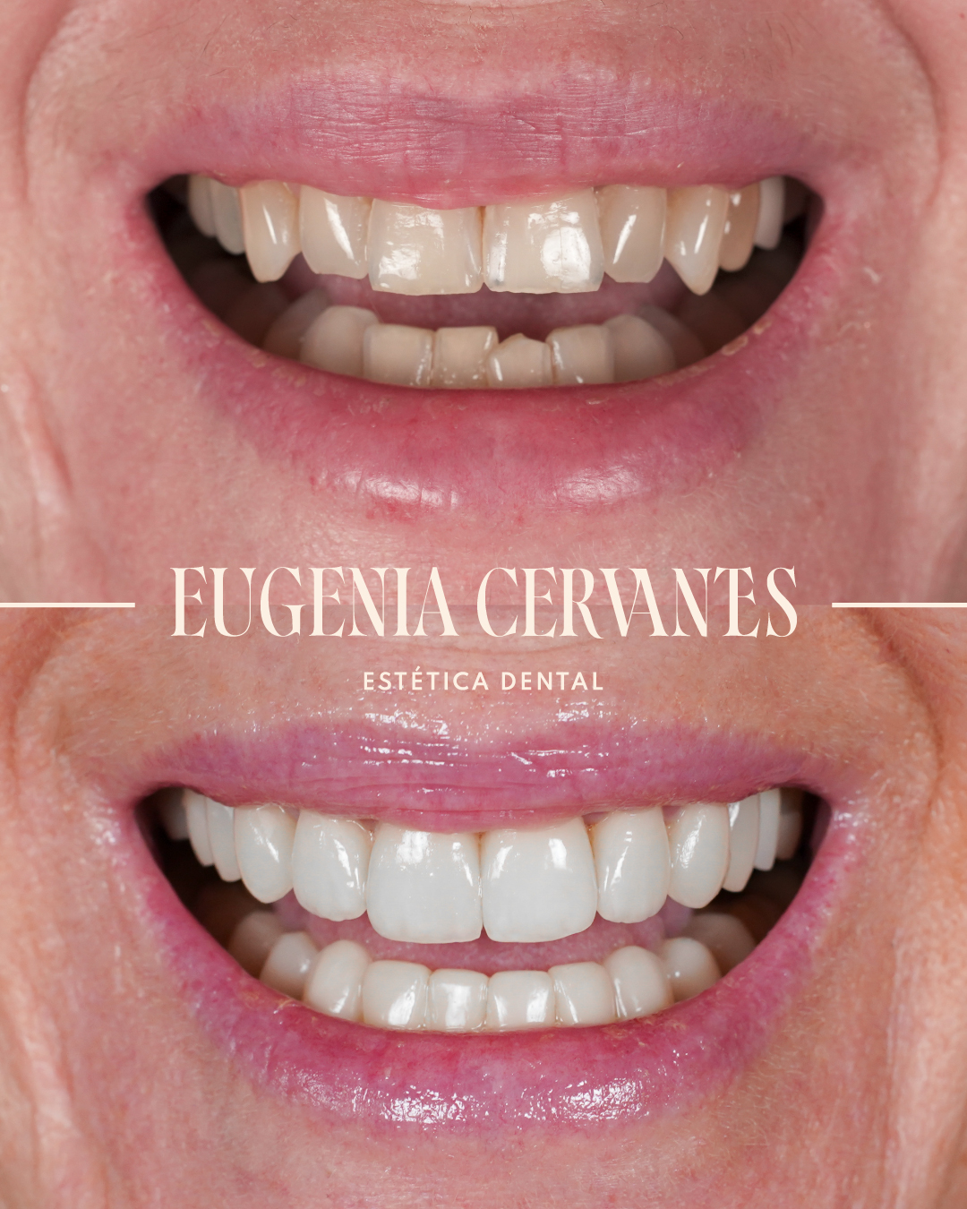 Antes y Despues Amaya Aragon BOCA FRONTAL Eugenia Cervantes | Clínica Dental en Madrid