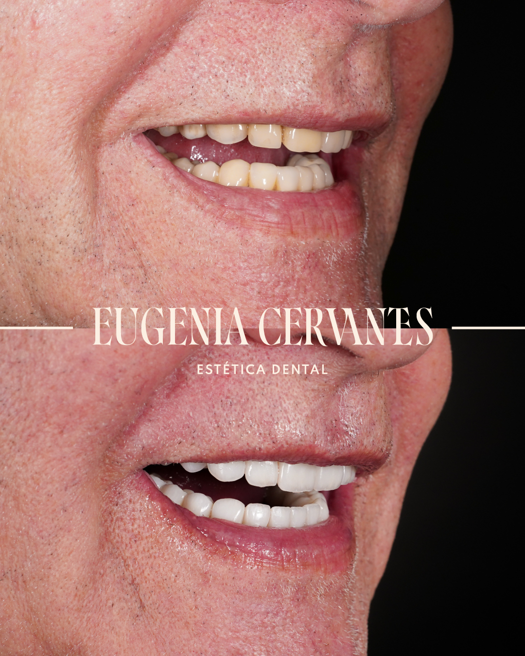 CARILLAS DE PORCELANA CARILLAS DE RESINA