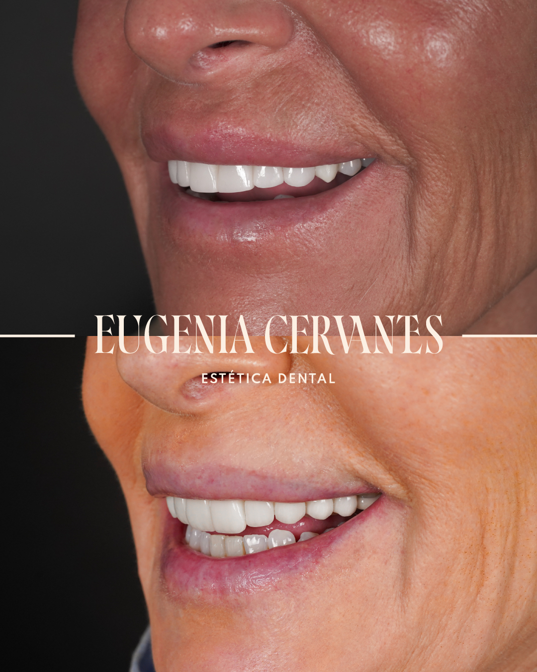 Antes y Despues Paloma Bordallo LATERAL BOCA Eugenia Cervantes | Clínica Dental en Madrid