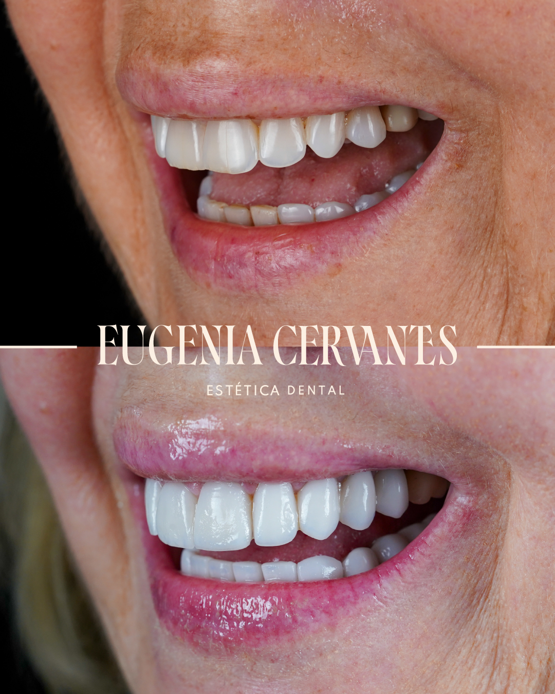 carillas de porcelana, carillas de resina