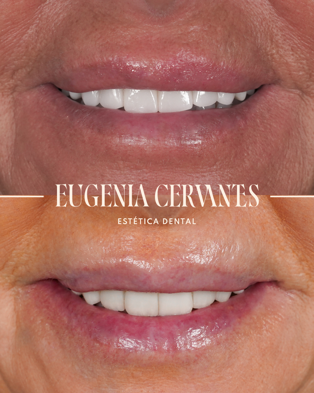 Antes y Despues Paloma Bordallo FRONTAL BOCA Eugenia Cervantes | Clínica Dental en Madrid