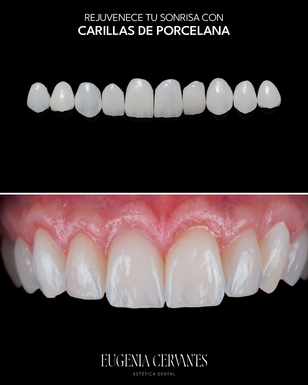 carillas de porcelana Eugenia Cervantes | Clínica Dental en Madrid