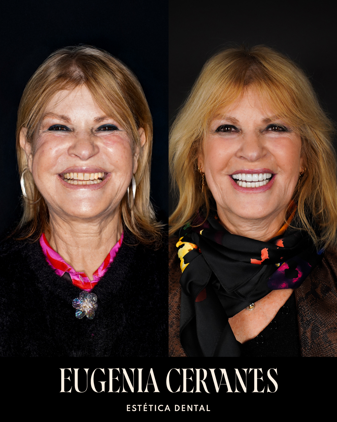 Antes y Despues Olga De La Pinta CARA BOCA Eugenia Cervantes | Clínica Dental en Madrid