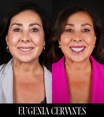 Antes y Después - María José Perez - CARA